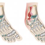как лечить растяжение связок голеностопного сустава