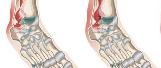 как лечить растяжение связок голеностопного сустава