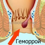 Как выглядит геморрой