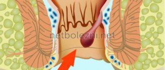 Как выглядит геморрой