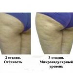 Кофейное обертывание от целлюлита в домашних условиях