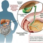 Можно ли пить кофе при холецистите
