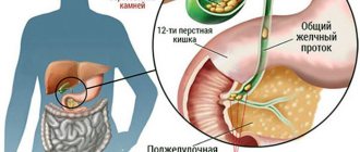 Можно ли пить кофе при холецистите